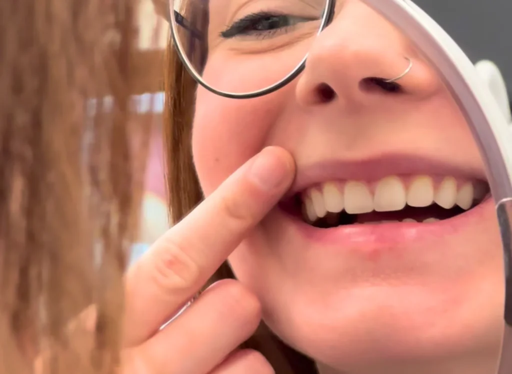 Cosa sono le faccette dentali? La guida completa per un sorriso estetico e naturale 1 cosa sono le faccette dentali