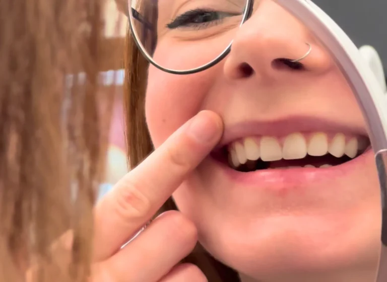 Blog 2 cosa sono le faccette dentali