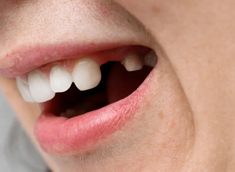 cade un dente permanente da adulto
