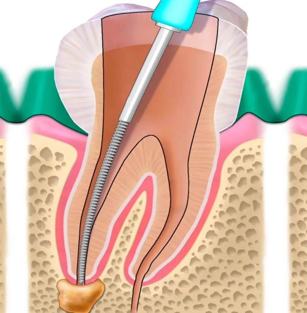 Endodonzia 1 devitalizzazione dente a Pomezia