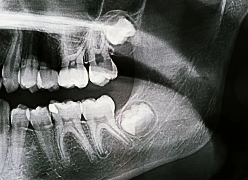 Falsi miti sull’estrazione dei denti del giudizio 1 estrazione dei denti del giudizio