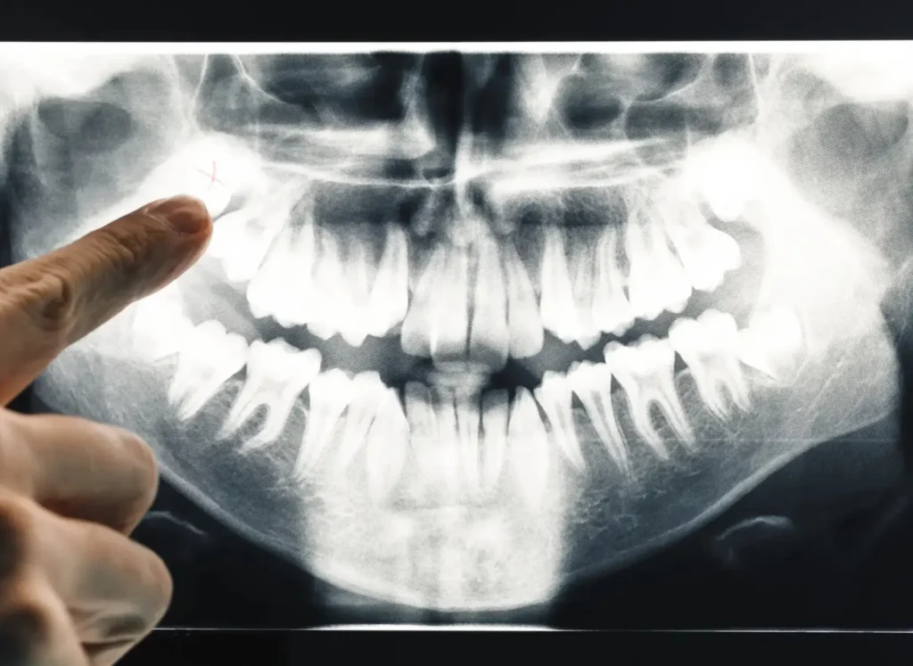 Falsi miti sull’estrazione dei denti del giudizio 2 estrazione dei denti del giudizio