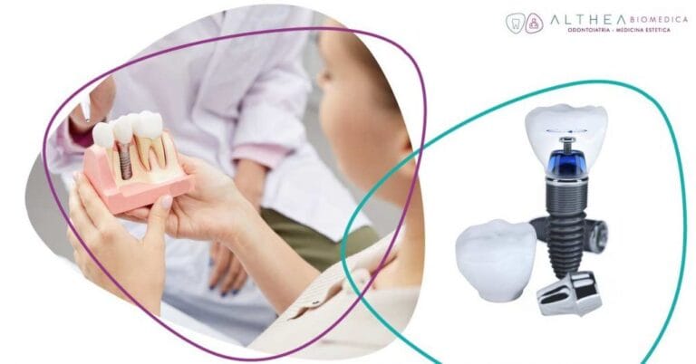 Blog 5 fasi dell'impianto dentale