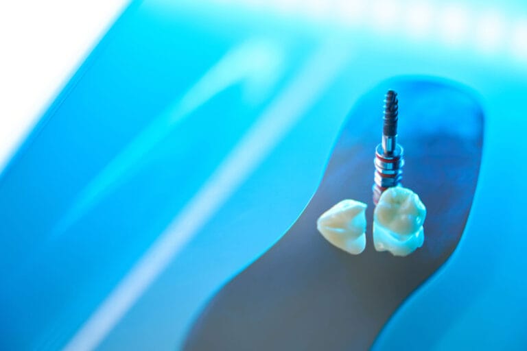 glossario implantologia dentale a Pomezia
