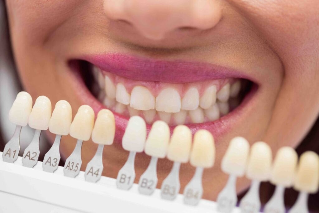Come si mettono le faccette dentali: guida completa al tuo nuovo sorriso 1 Come si mettono le faccette dentali