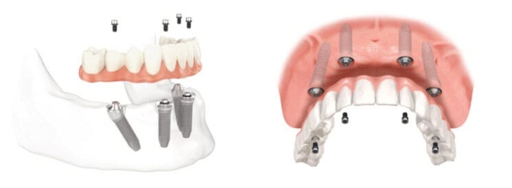 Implantologia 5 impianto dentale a Pomezia